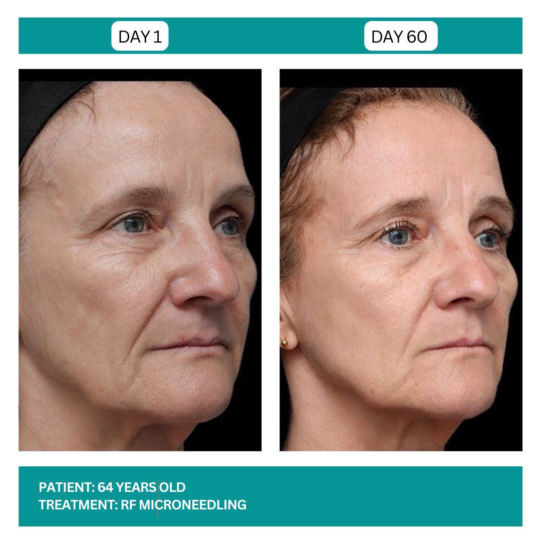 RF MICRONEEDLING - 4