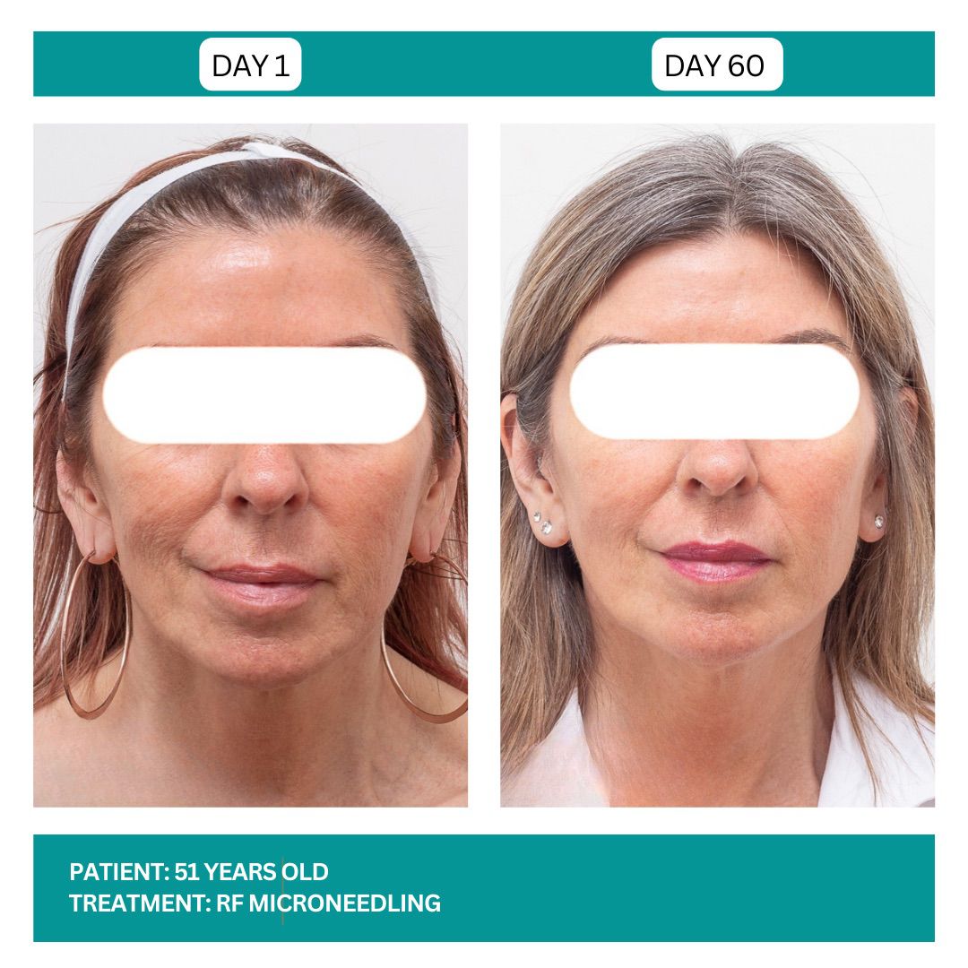 RF MICRONEEDLING - 5