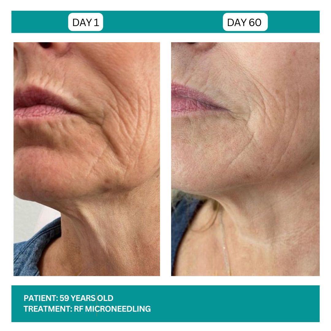 RF MICRONEEDLING - 3