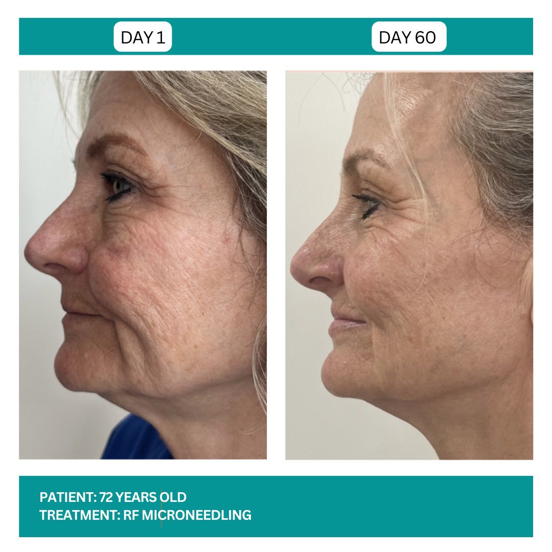 RF MICRONEEDLING - 1