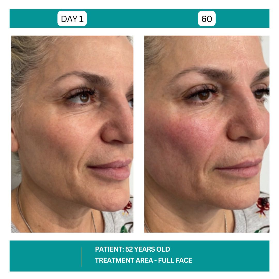 STADIA SKINPEN BEFORE AND AFTER - 11