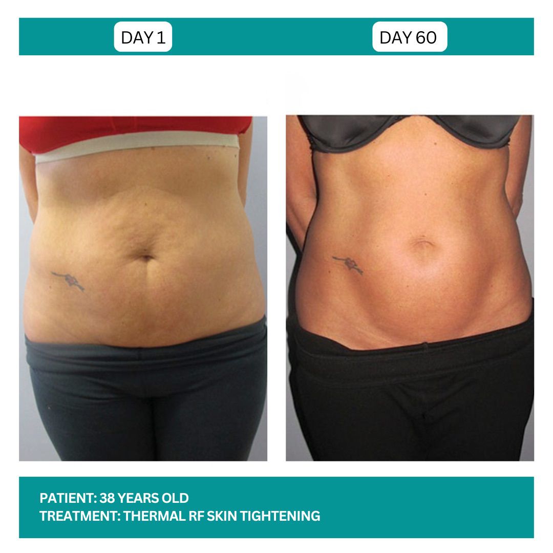 SKIN TIGHTENING BEFORE AND AFTER - 4