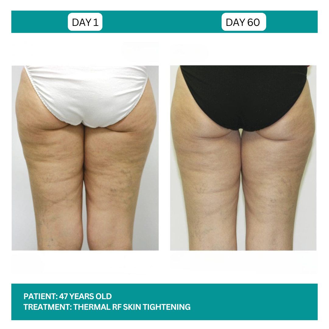 SKIN TIGHTENING BEFORE AND AFTER - 5