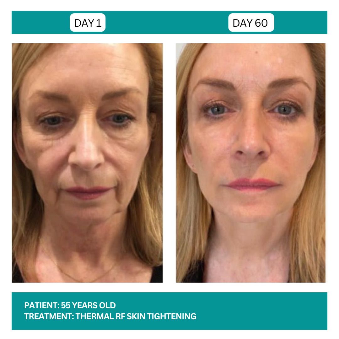SKIN TIGHTENING BEFORE AND AFTER - 2
