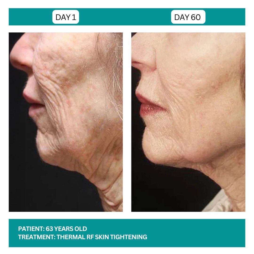 SKIN TIGHTENING BEFORE AND AFTER - 3