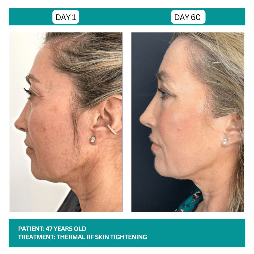 SKIN TIGHTENING BEFORE AND AFTER - 1