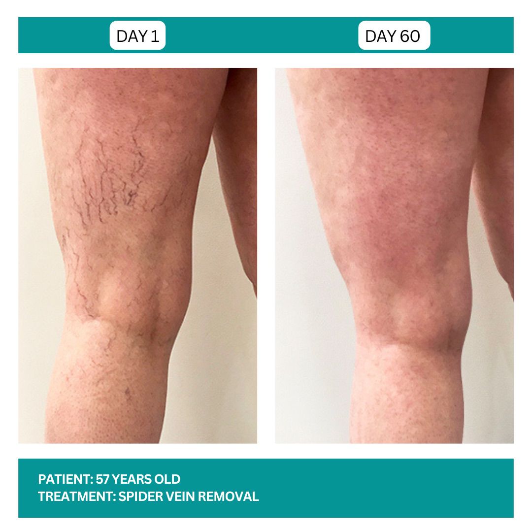 Spider Vein Removal Stadia 2025 - 4