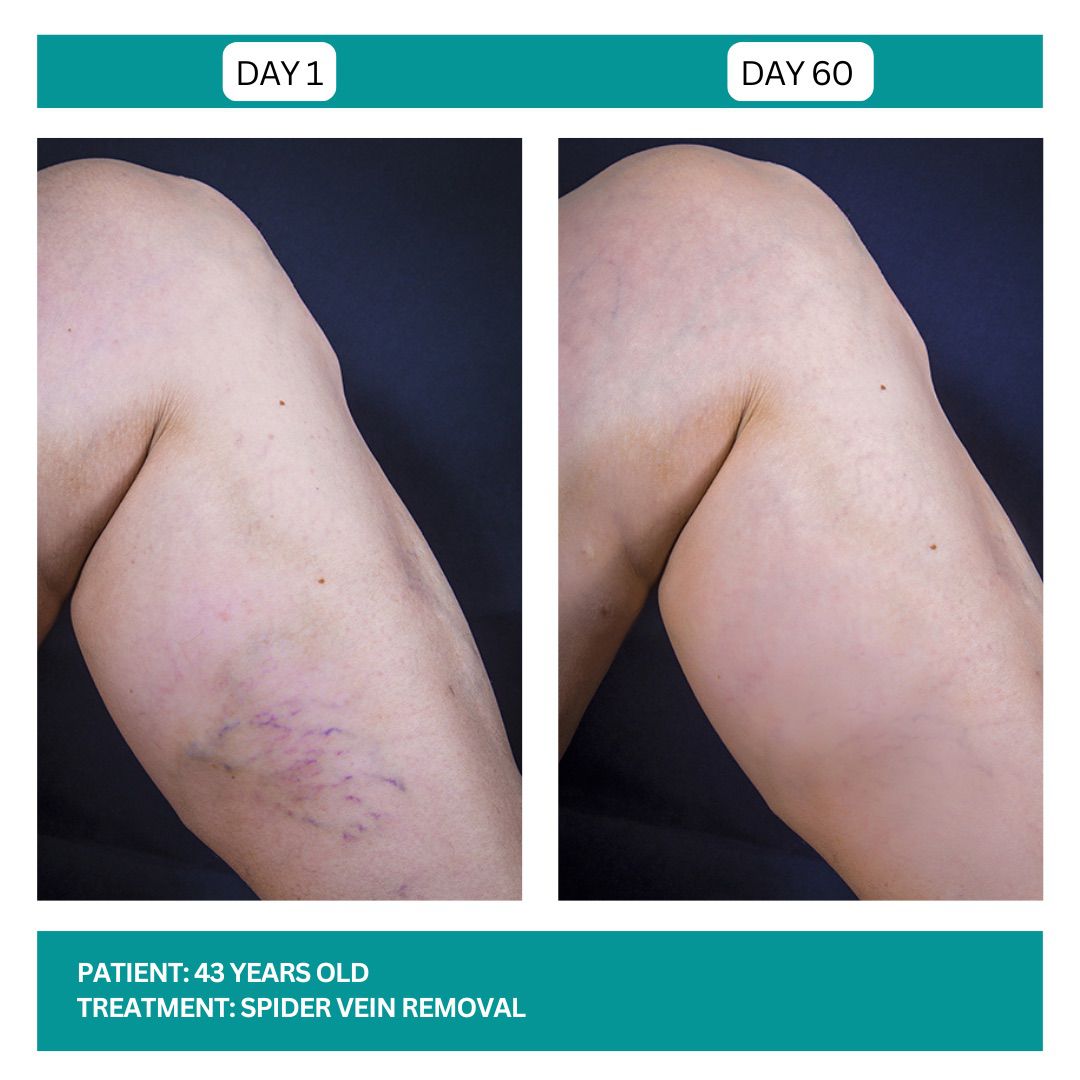 Spider Vein Removal Stadia 2025 - 5