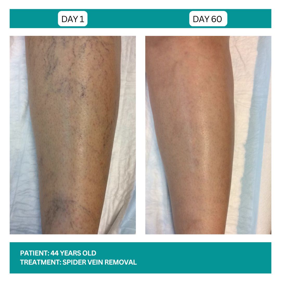 Spider Vein Removal Stadia 2025 - 2