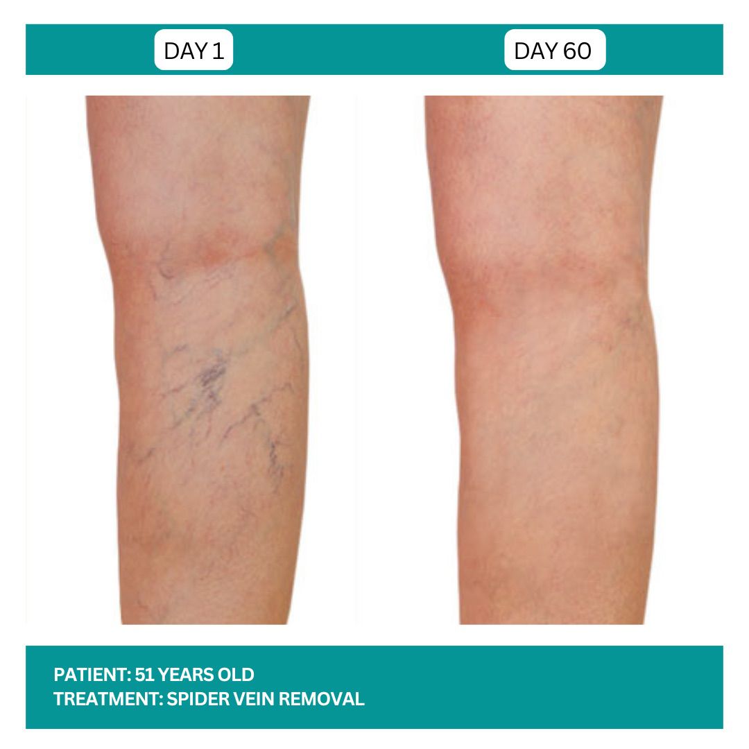 Spider Vein Removal Stadia 2025 - 3
