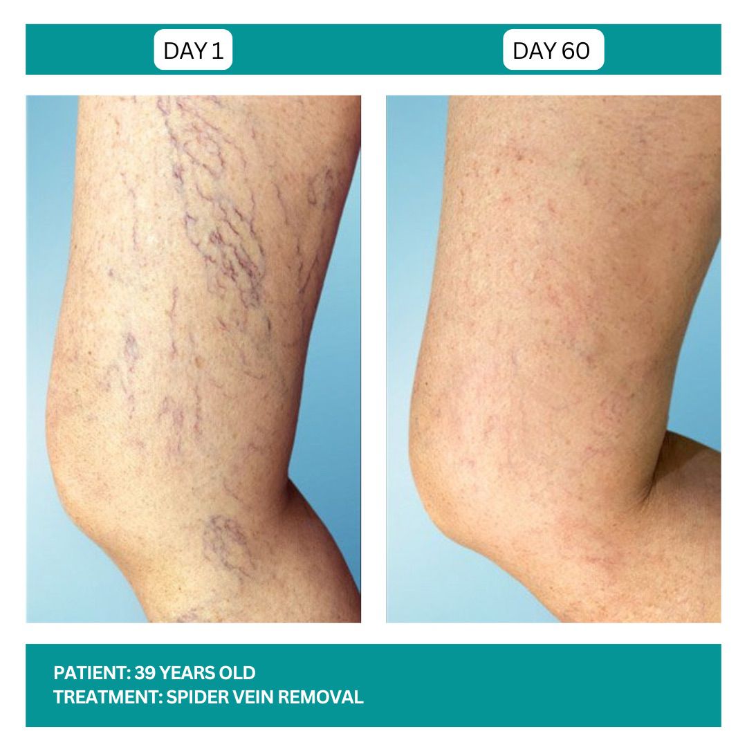 Spider Vein Removal Stadia 2025 - 1