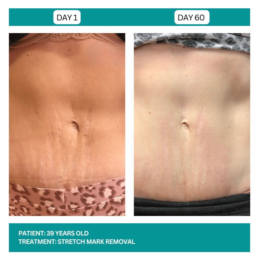 Stretch Mark Removal Stadia 2025 - 4