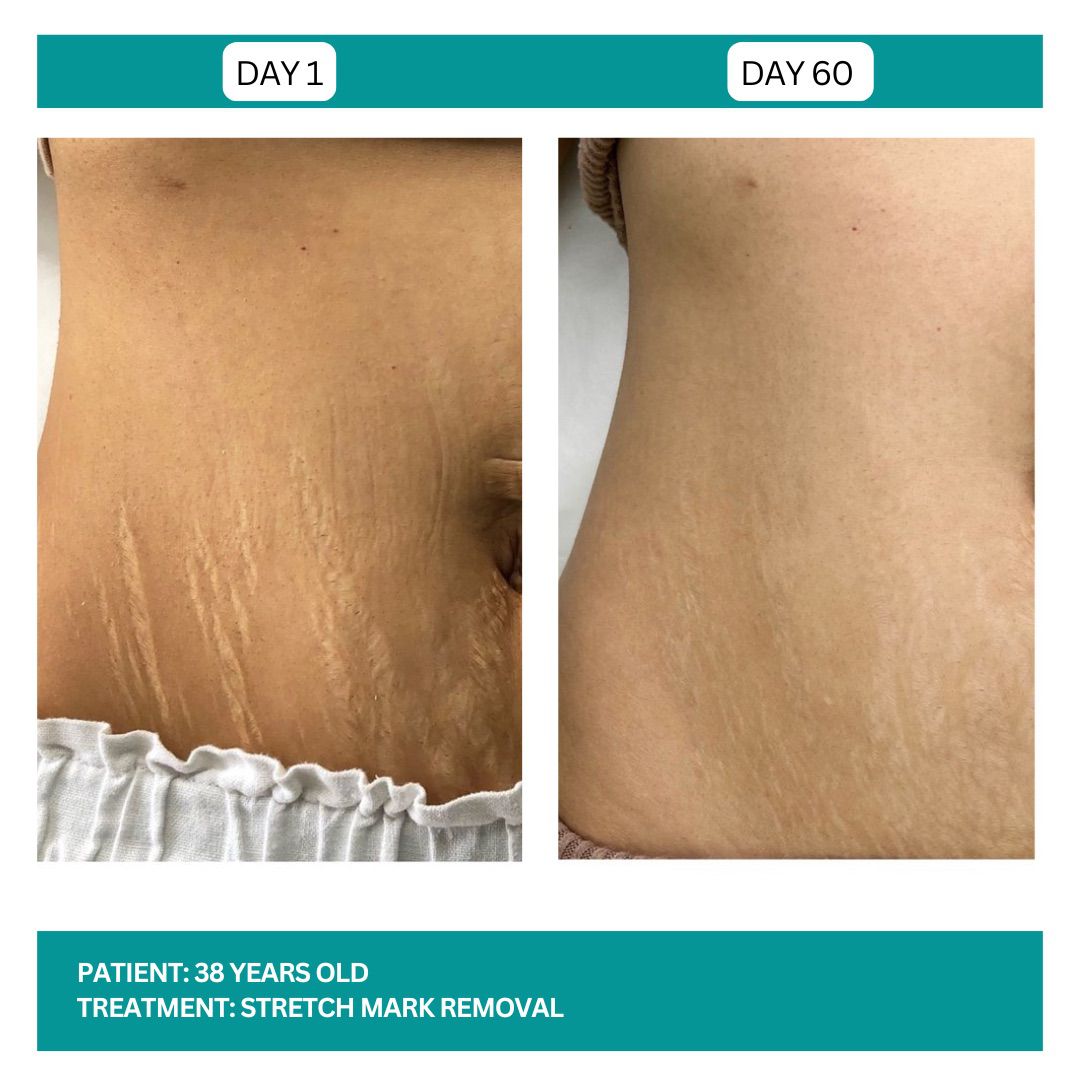 Stretch Mark Removal Stadia 2025 - 5