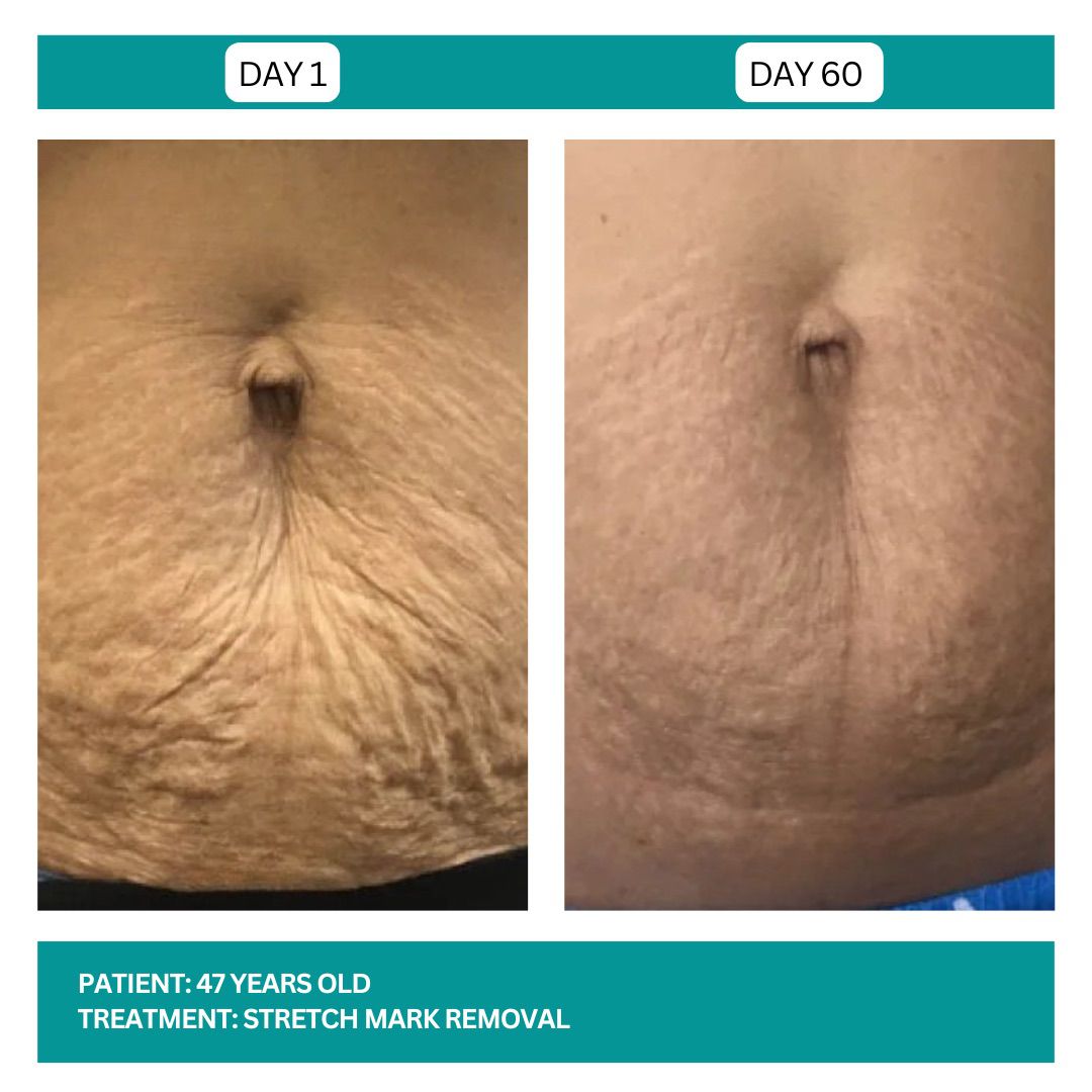 Stretch Mark Removal Stadia 2025 - 3