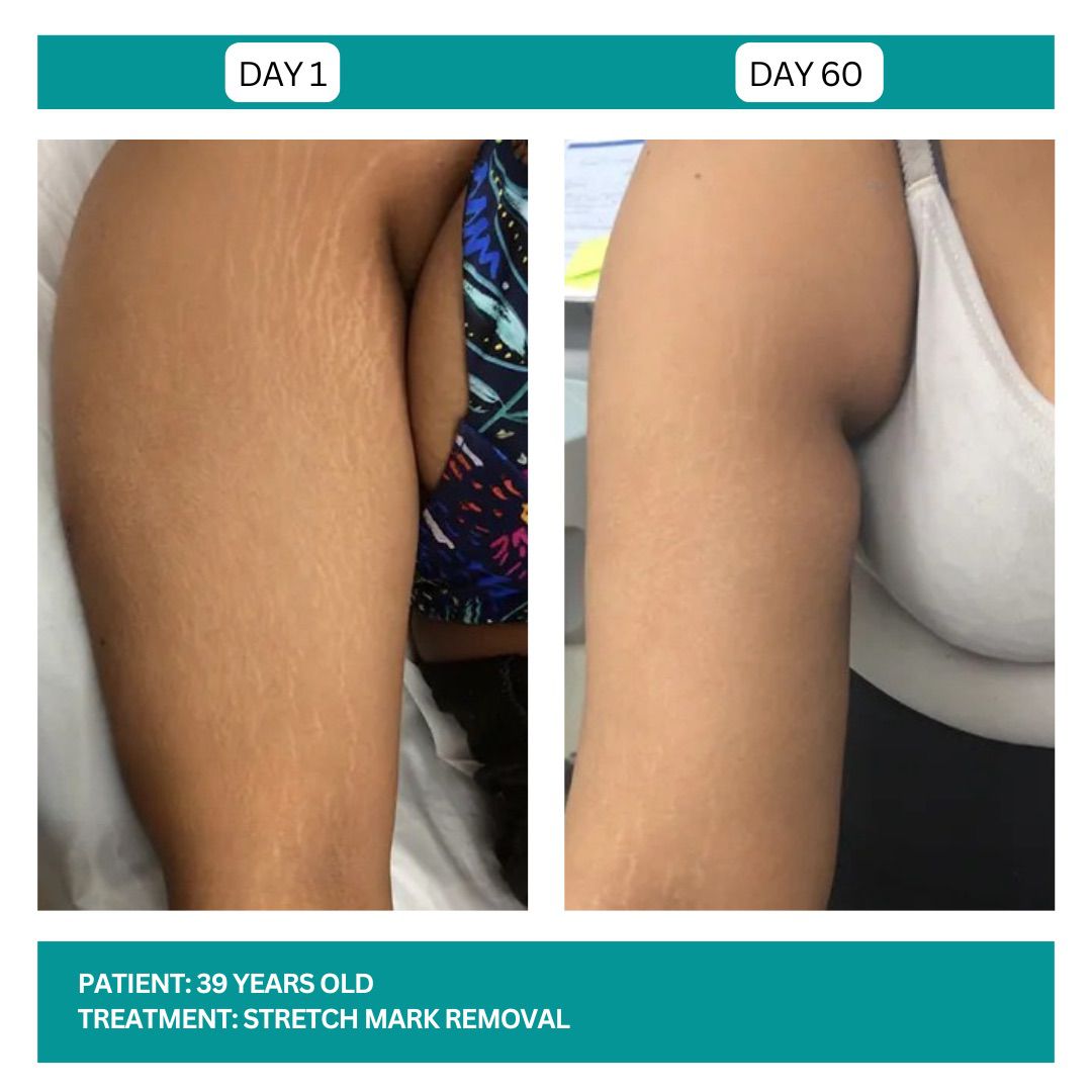 Stretch Mark Removal Stadia 2025 - 1