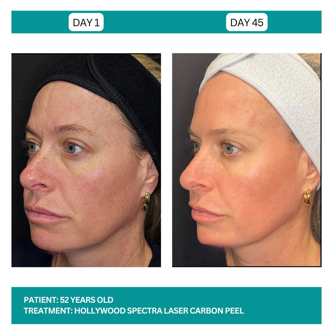 Hollywood Carbon Peel B&A - 1