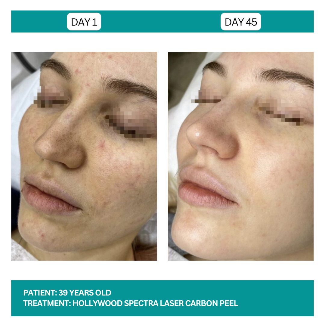 Hollywood Carbon Peel B&A - 2