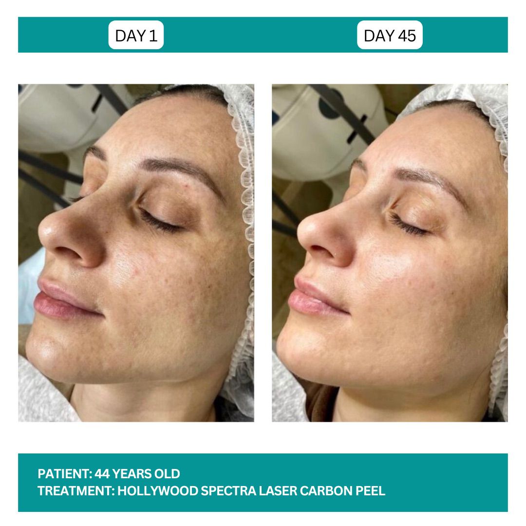 Hollywood Carbon Peel B&A - 3