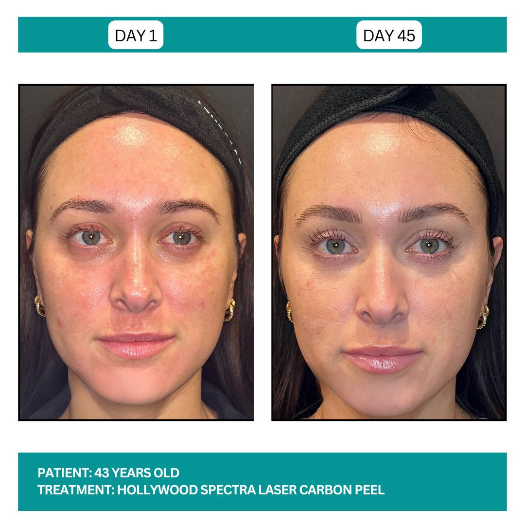 Hollywood Carbon Peel B&A - 4