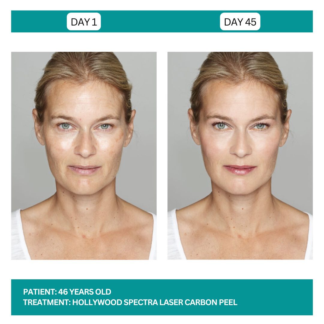 Hollywood Carbon Peel B&A - 5