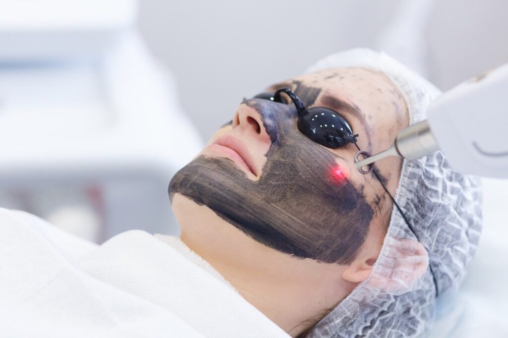 Carbon laser peel treatment in san antonio at Stadia Med Spa