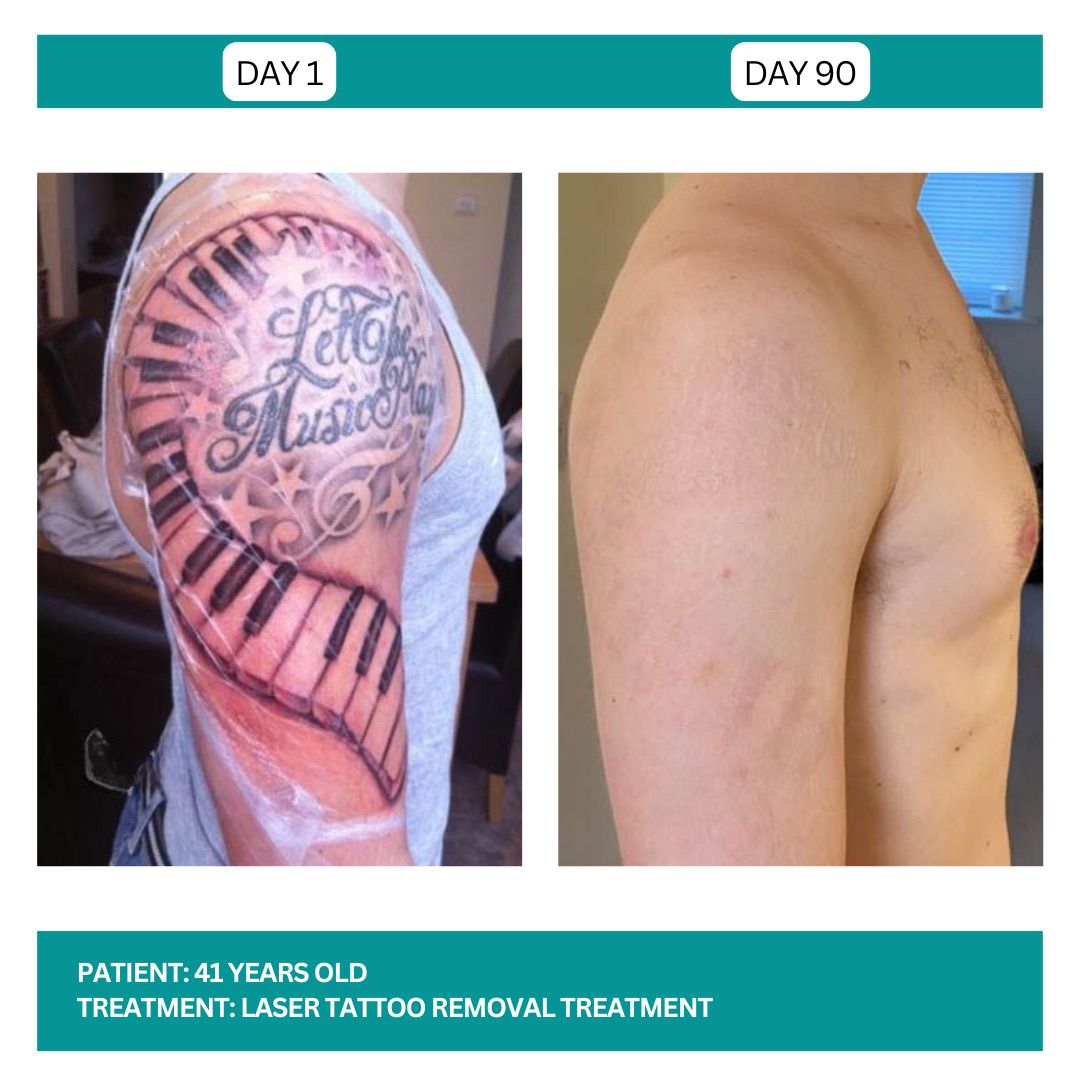 Laser Tattoo Removal B&A - 2