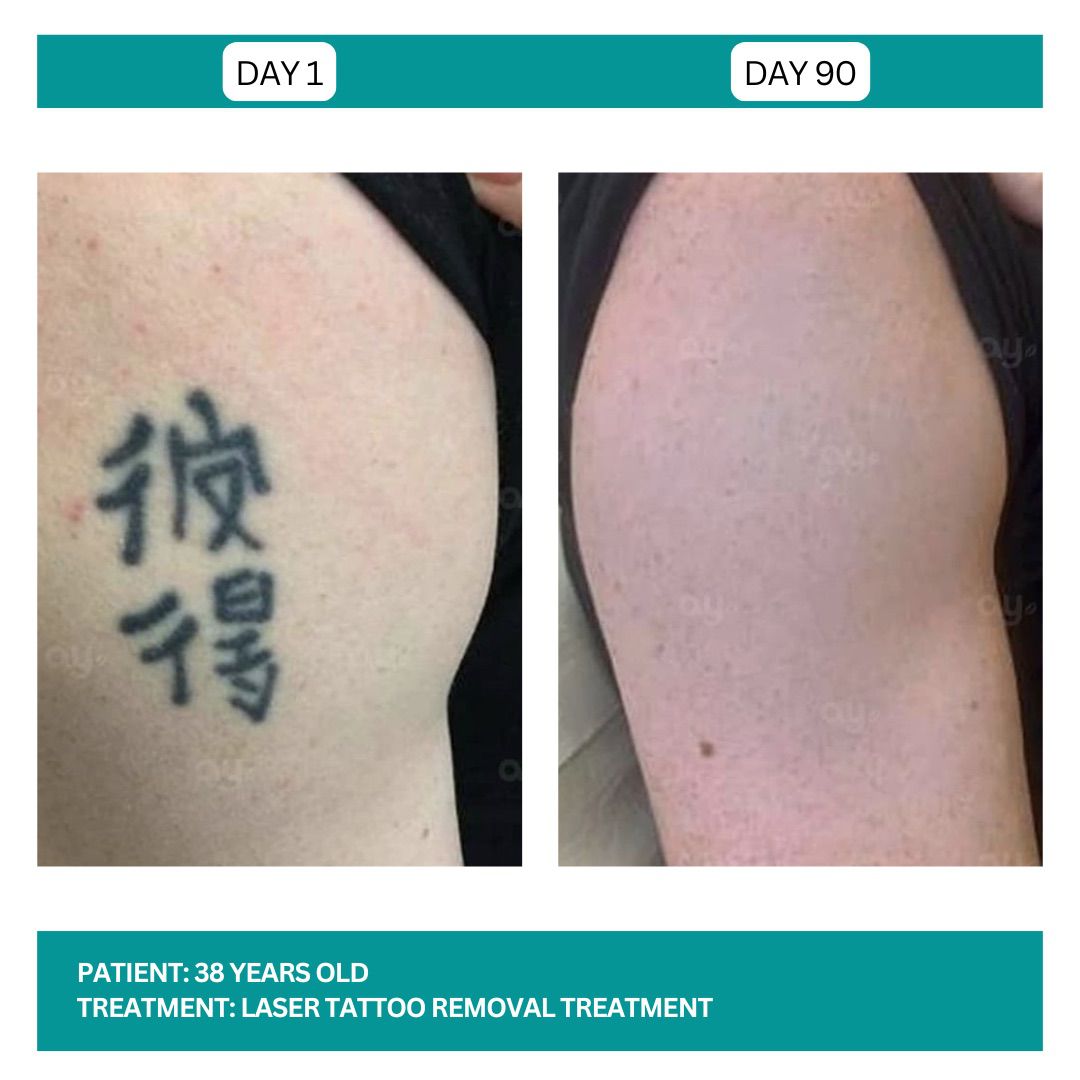 Laser Tattoo Removal B&A - 3