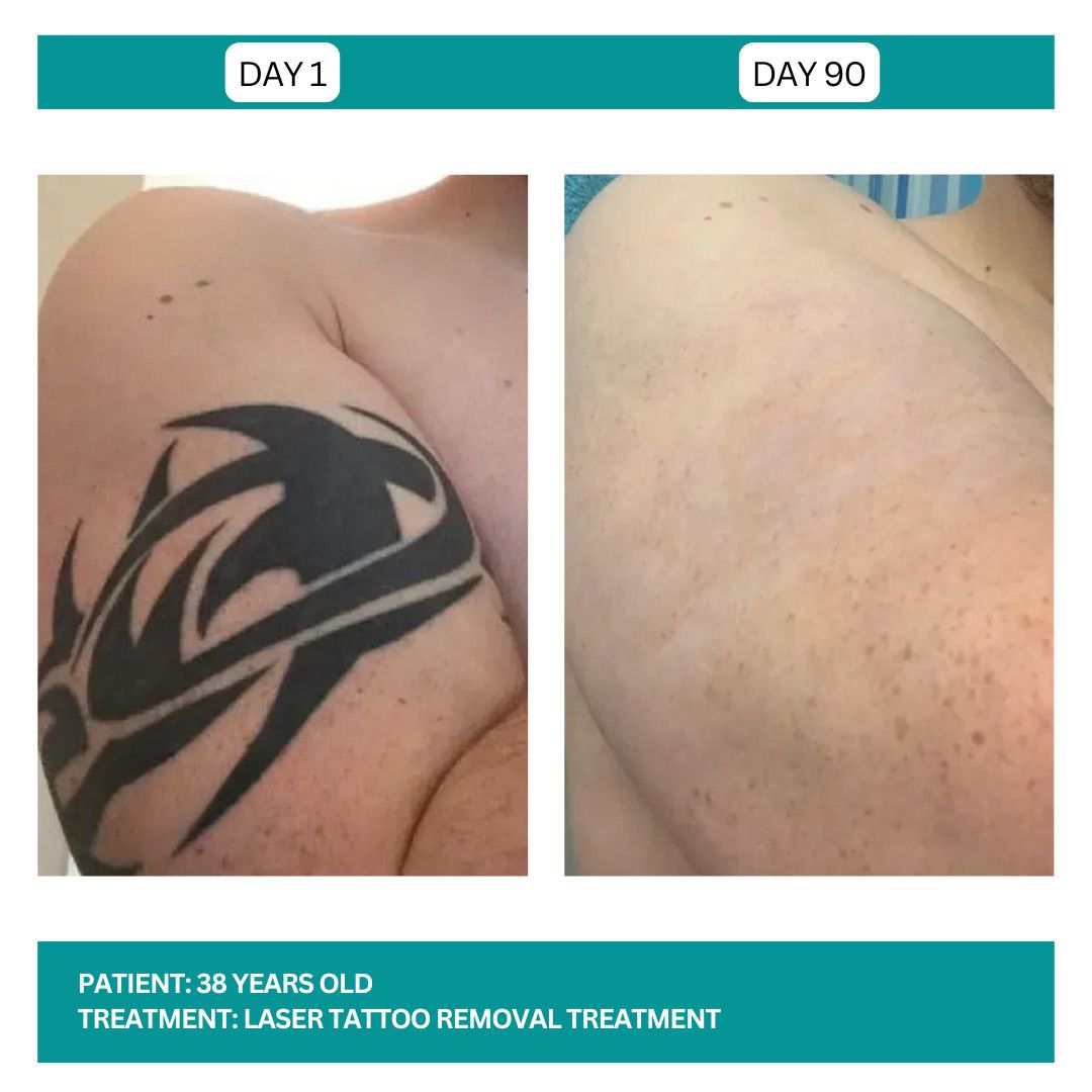 Laser Tattoo Removal B&A - 4