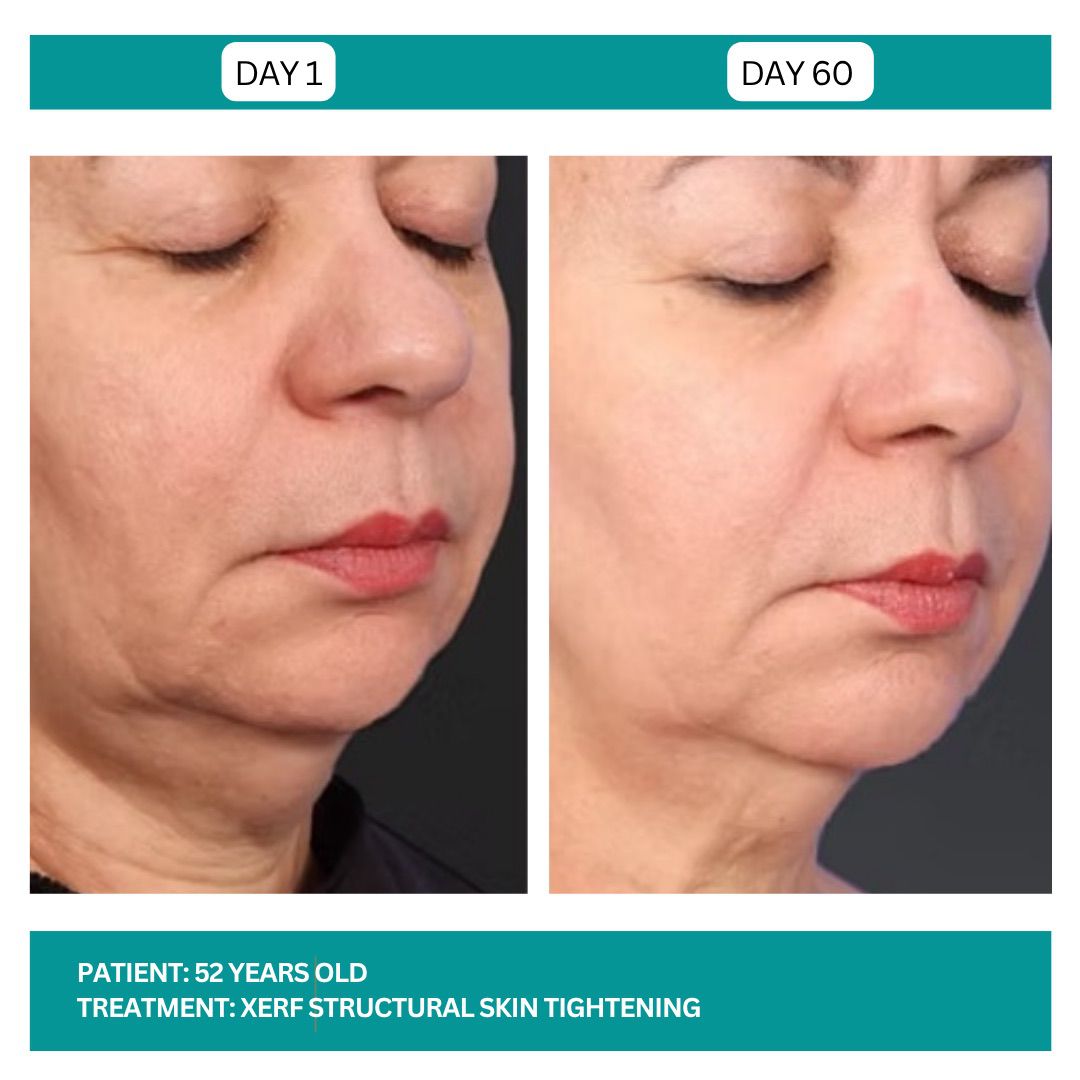Lutronic XERF RF Skin Tightening Before After-2