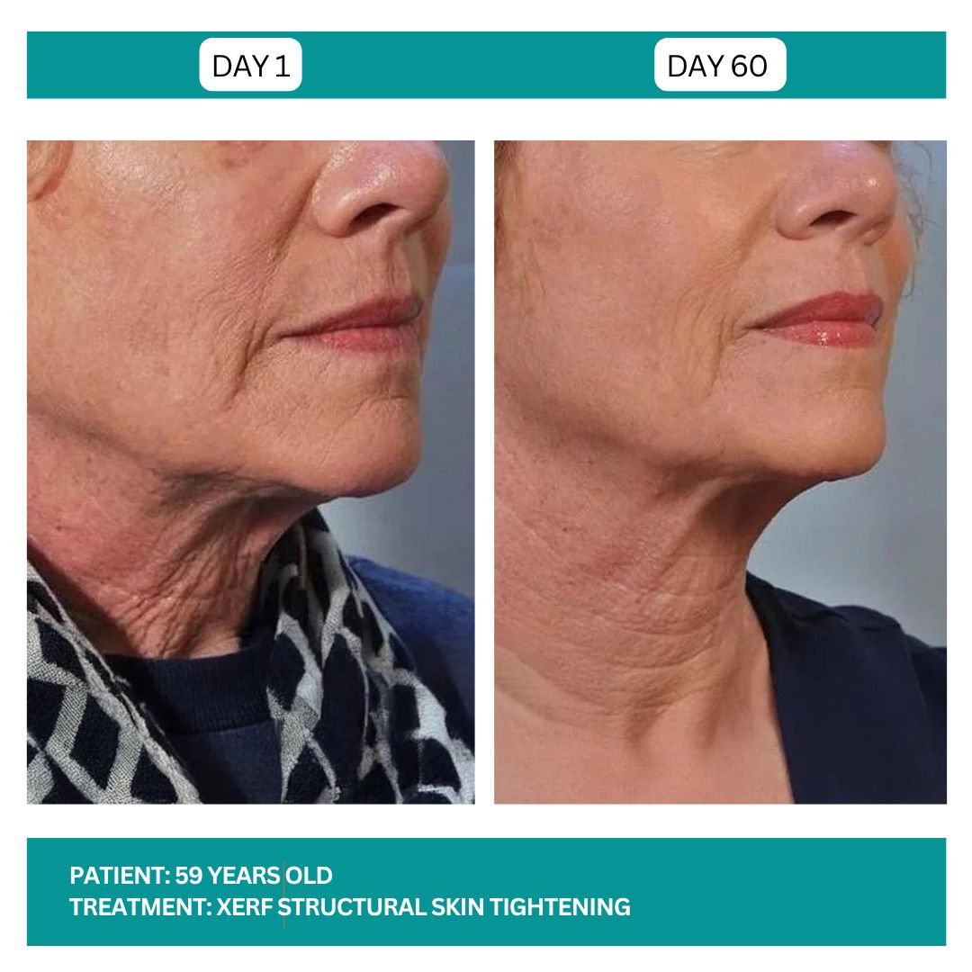 Lutronic XERF RF Skin Tightening Before After-3
