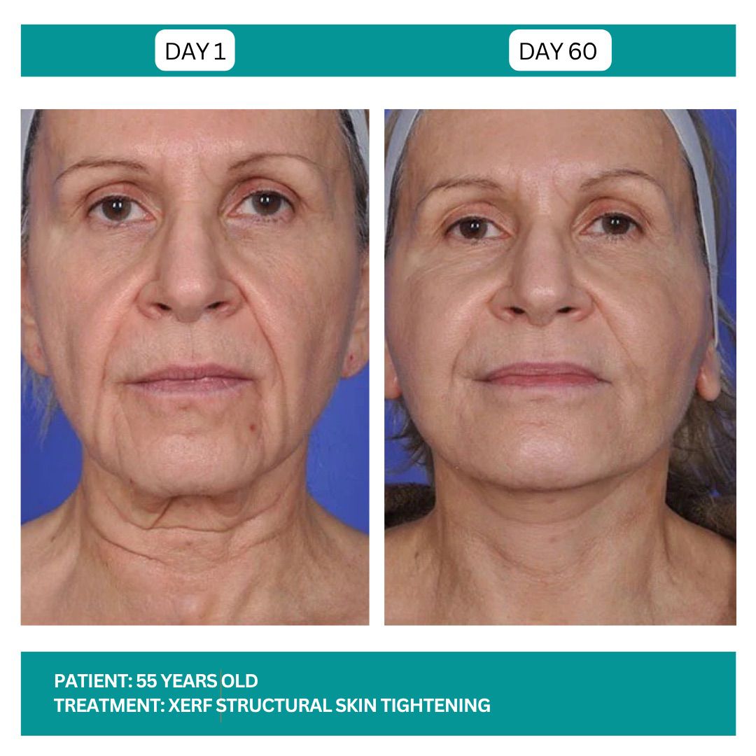 Lutronic XERF RF Skin Tightening Before After-4