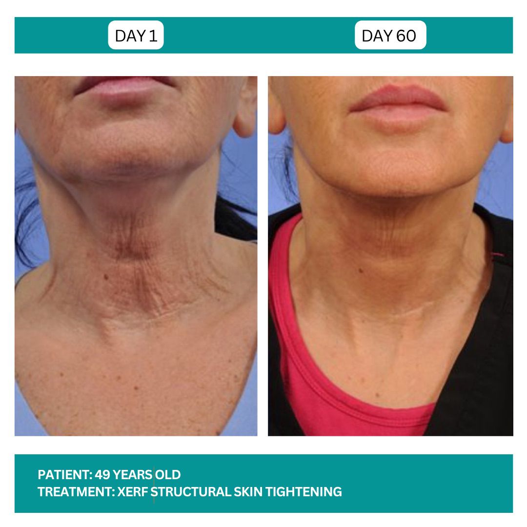 Lutronic XERF RF Skin Tightening Before After-5