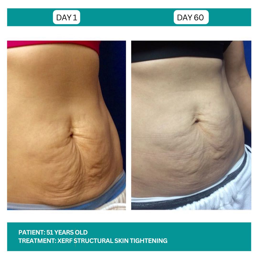 Lutronic XERF RF Skin Tightening Before After-6